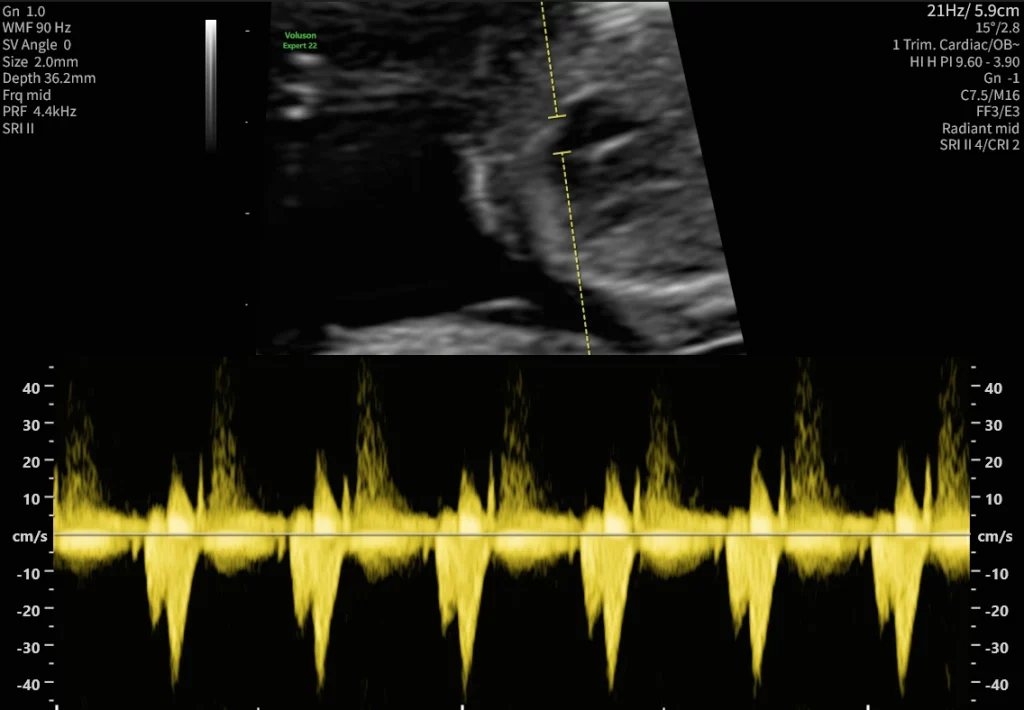 Ersttrimester-Screening