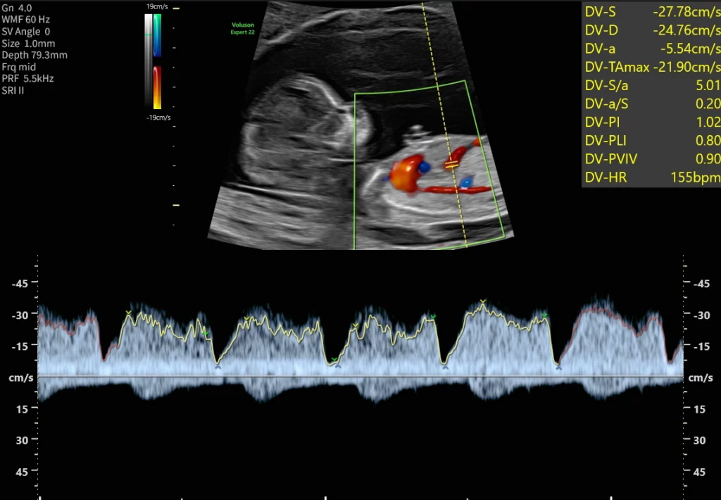 Ersttrimester-Screening